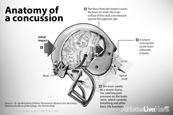 Concussions-in-the-NFL
